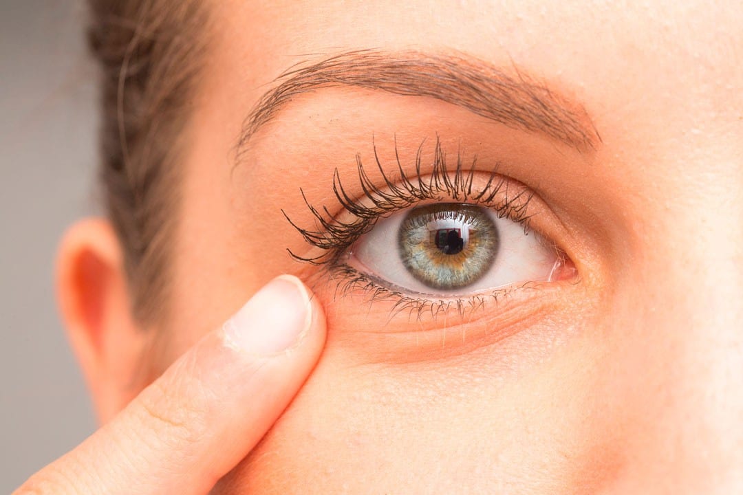 Eliminar las bolsas debajo de los ojos sin cirugía