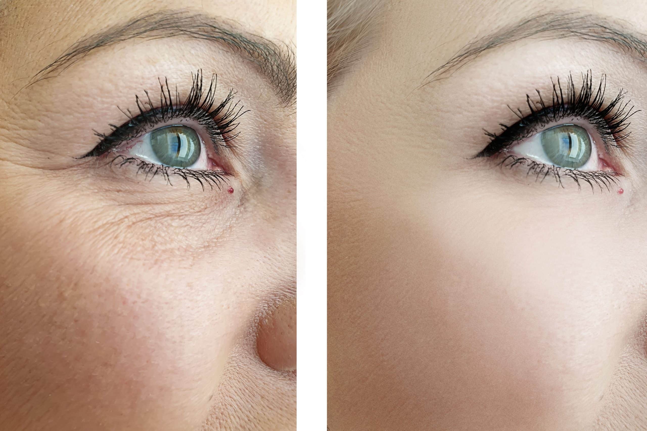 Eliminar las bolsas debajo de los ojos sin cirugía