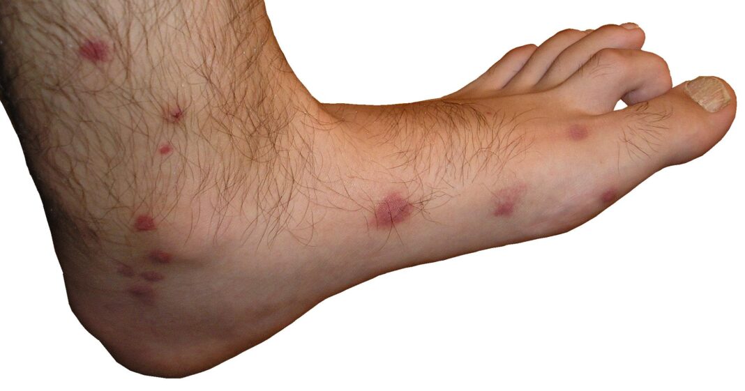 Picaduras de arañas en niños: Cómo tratarlas